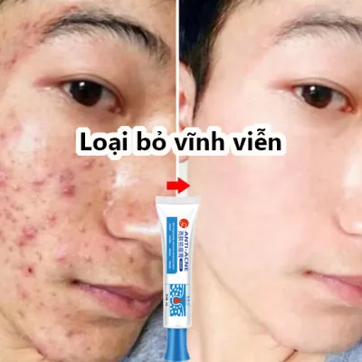 Highly Effective and Fast-Acting Acne Treatment Cream, Cream to Fade and Restore Acne Scars, Facial Care Cream, Pore Minimizing Cream, Acne Skin Cleansing Cream