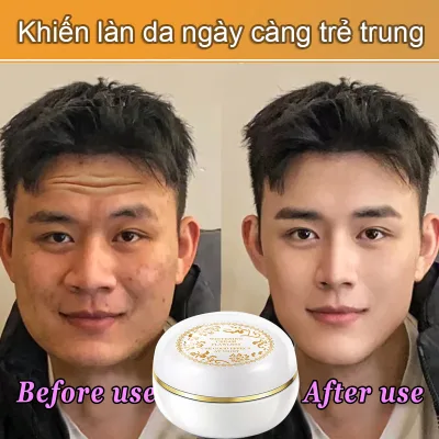 Kem dưỡng trắng tàn nhang hiệu quả nâng cấp mới loại bỏ các vết thâm mụn melanin gel dưỡng ẩm chăm sóc da chăm sóc cá nhân 30g