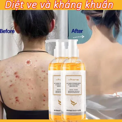 Sữa tắm kháng khuẩn trị mụn 500ml trị mụn và ngứa cải thiện làn da làm sạch sâu chăm sóc cá nhân nhẹ nhàng không gây kích ứng