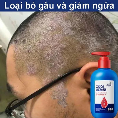 Dầu Gội Thảo Mộc Giảm Gàu, Nấm Ngứa Da Đầu，Chăm sóc da đầu, kiểm soát dầu, làm bồng bềnh tóc, hương thơm lâu trôi