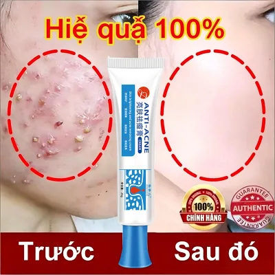 Acne Removal Cream 25g Reduces Acne, Controls Oil, Fades Acne Scars, Cares for Skin, Eliminates Acne for Oily Skin