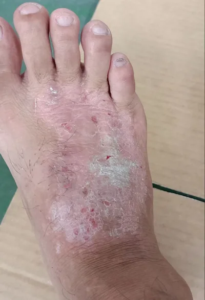 Eliminate Skin Inflammation, Treat Fungal Skin on Hands and Feet in the Groin Area, Hands, Psoriasis Cream, Improve Skin Care