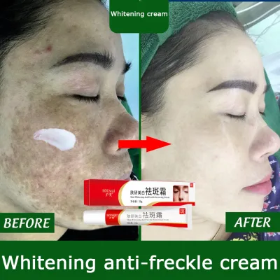 Kem dưỡng trắng và chống tàn nhang hiệu quả 100%, kem dưỡng ẩm, kem làm trắng chống tàn nhang, phục hồi các đốm đồi mồi và sắc tố da để làm sáng tông màu da, chăm sóc cá nhân 20g