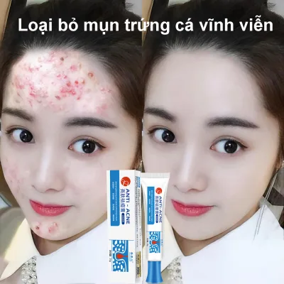 Kem trị mụn, thu nhỏ lỗ chân lông, nhanh chóng loại bỏ mụn đầu đen, kiểm soát dầu, phục hồi vết tích mụn và chống viêm mụn, kem dưỡng trắng, chăm sóc da