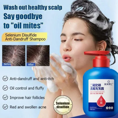 Dầu gội trị nấm trị gàu 300ml dầu gội trị gàu selen disulfide chống ngứa kiểm soát dầu phục hồi da bị viêm da nhẹ không gây tổn thương da chăm sóc cá nhân